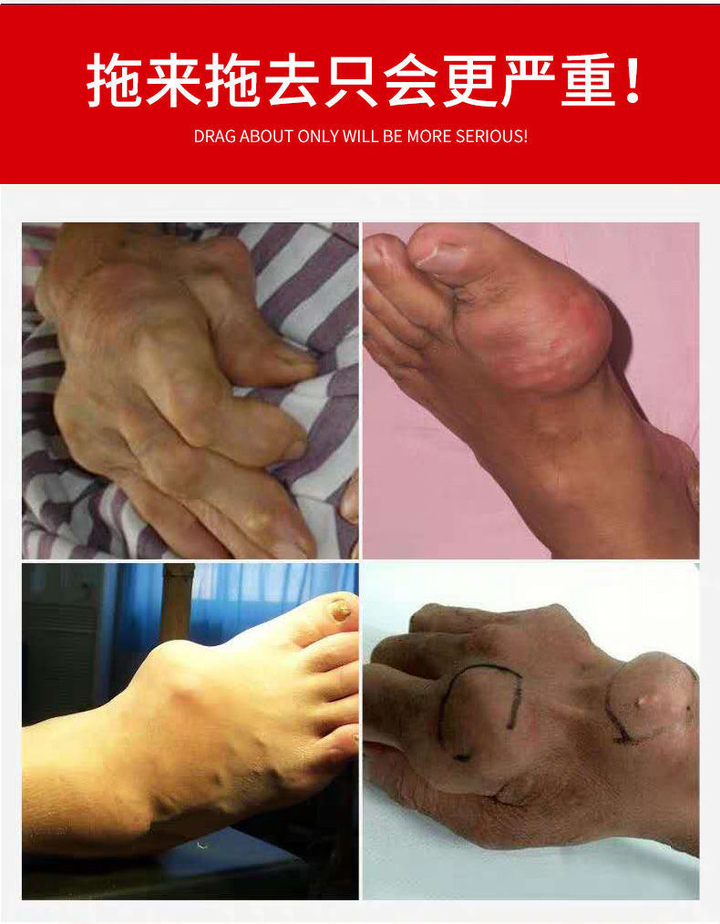 囍成双痛风克星痛风膏消结晶脚趾关节红肿鼓包变形专用痛风克星痛风膏