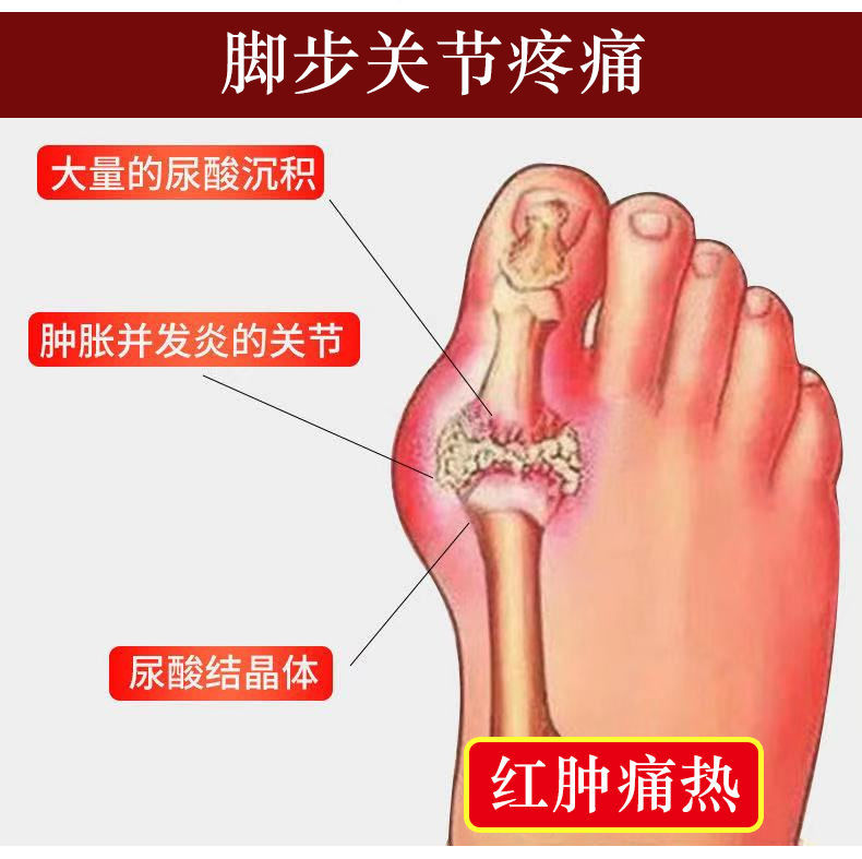 痛风喷剂痛风克星痛风灵尿酸高降i尿酸大脚趾关节红肿鼓包变形 1瓶装