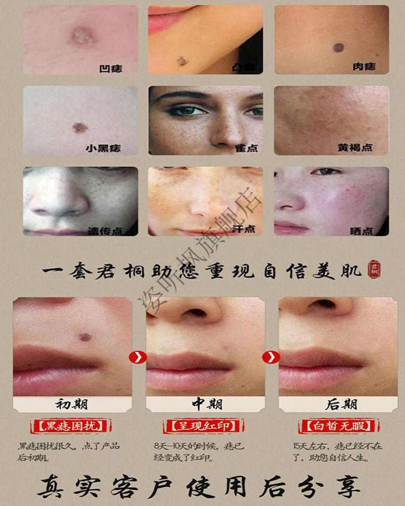点痣药水无痕痣套装痣学生脸部点痣膏斑点黑痣 志清宁一盒(痣液 痣膏)