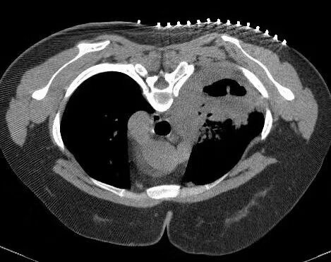 ct定位纸显影胶带肺部穿刺活检脊柱腰椎透视消融体表定位简易 二片装