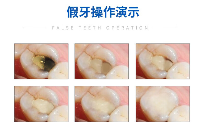 牙洞填充剂牙齿修复补牙洞材料自己补牙补缝补堵儿童