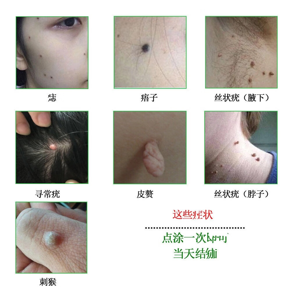 丝状尤去除小肉瘤肉猴子特效治刺肉膏肉粒老鼠奶老鼠痣疙瘩点黑痣去痣