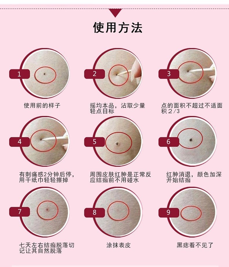 清赘点痣药水点痣膏去痣药水有外盒痕膏去黑痣点痣脸部去痣痣快速去痣