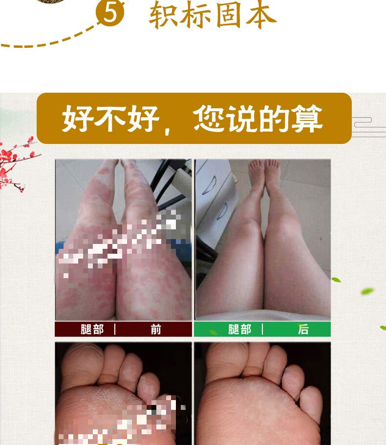 苗药牛癣体鲜股鲜手足屁股大腿根部痒湿痒止痒外用乳膏真菌感染内侧