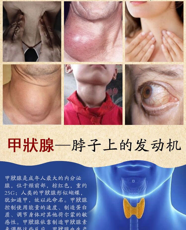 万人验证甲状腺凝胶结节贴脖子肿大结节膏颈部长瘿桥本氏甲腺5盒装i