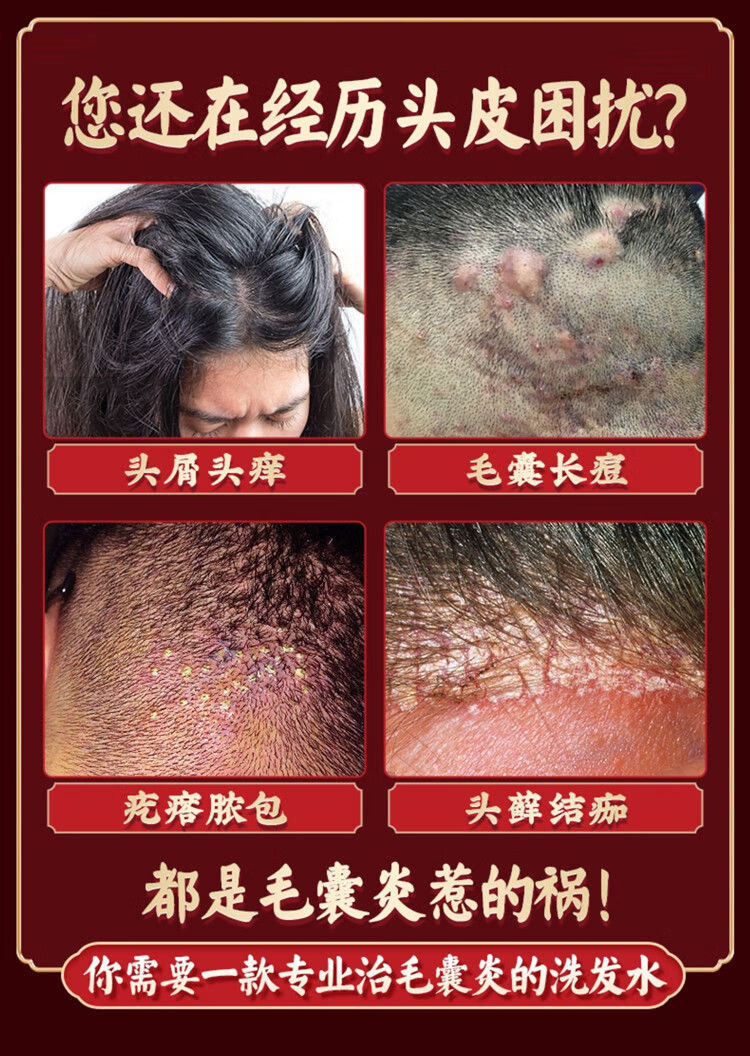 毛囊炎沐浴i露毛囊焱炎洗发水头皮清洁治头i癣除螨虫痘痘去屑止痒控油