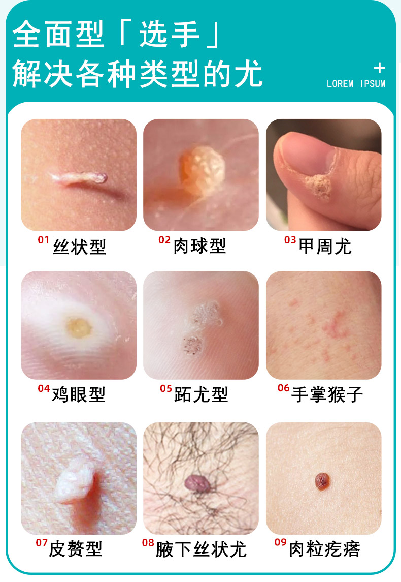 妥能 草本克疣液丝状疣脖子颈部去除肉粒疙瘩祛瘊子扁平尤克优膏疣瘊