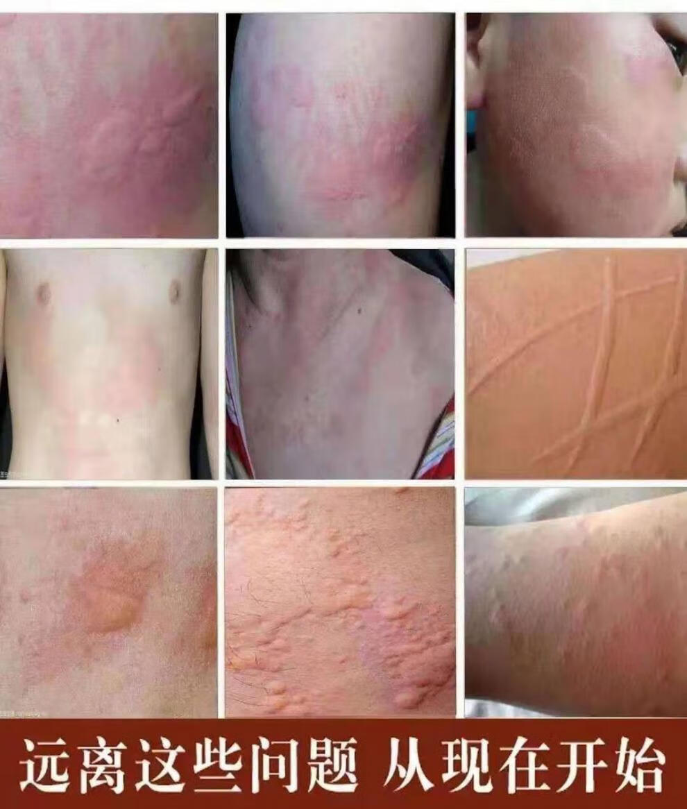 荨i麻l疹软膏过敏止痒外用急慢性风团皮肤过敏瘙痒划痕性皮l炎湿l疹