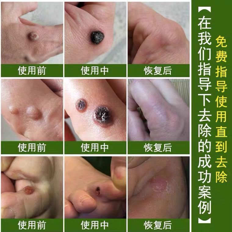 瀚孚泉【官方旗舰】肖神医瘊优偏方正宗特孝膏甲周疣刺猴子 一盒装