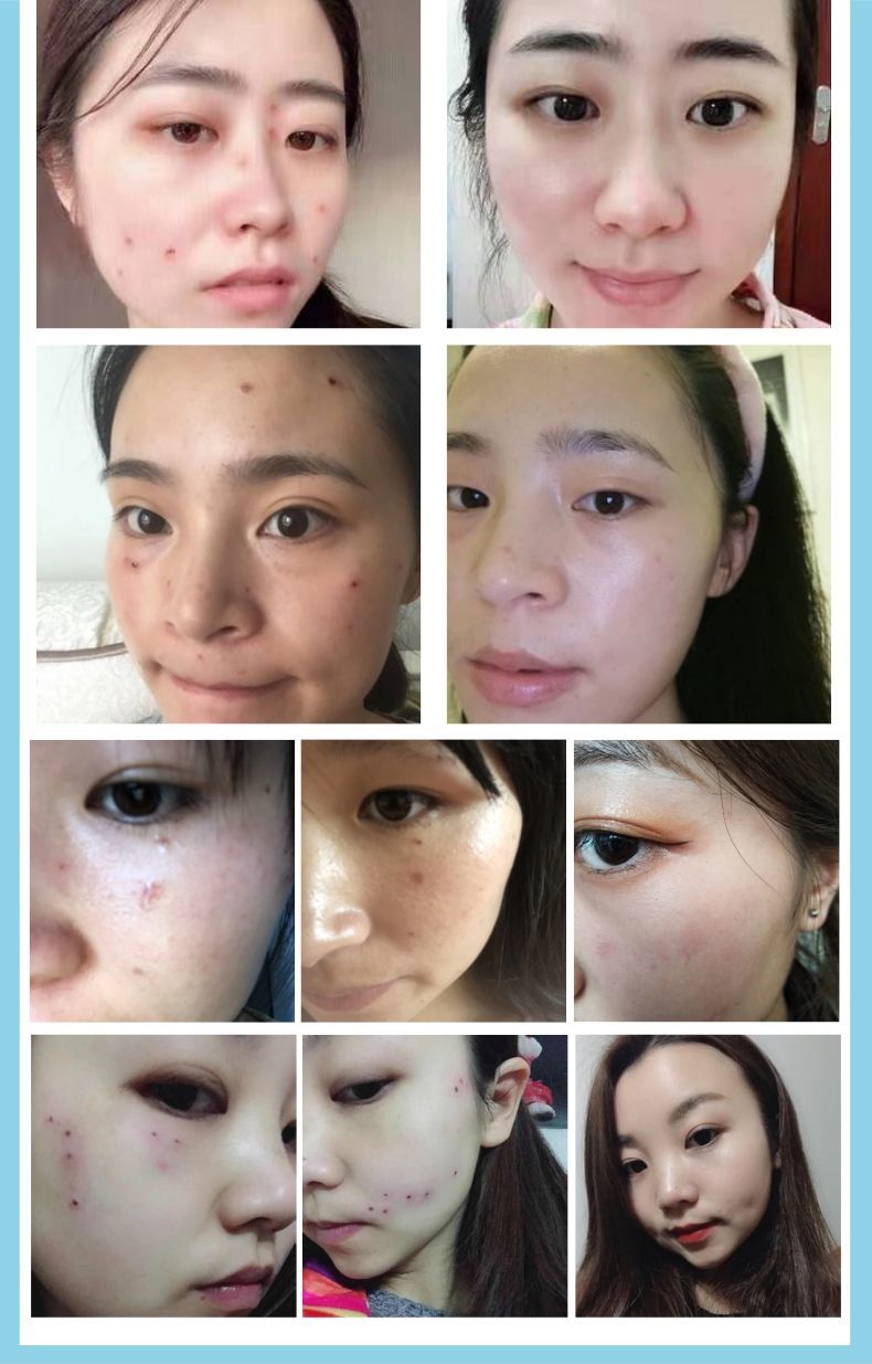 艾利莫森 点痣祛痣去斑后修复液冰晶防疤膏痕去红印凹坑黑色素印脸部