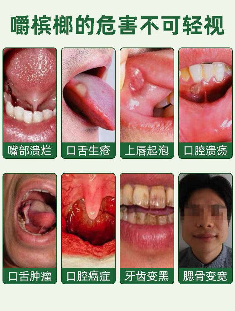 戒槟榔神器修复口腔粘膜纤维化口腔白斑症溃疡牙龈黑咬肌宽大槟榔嘴