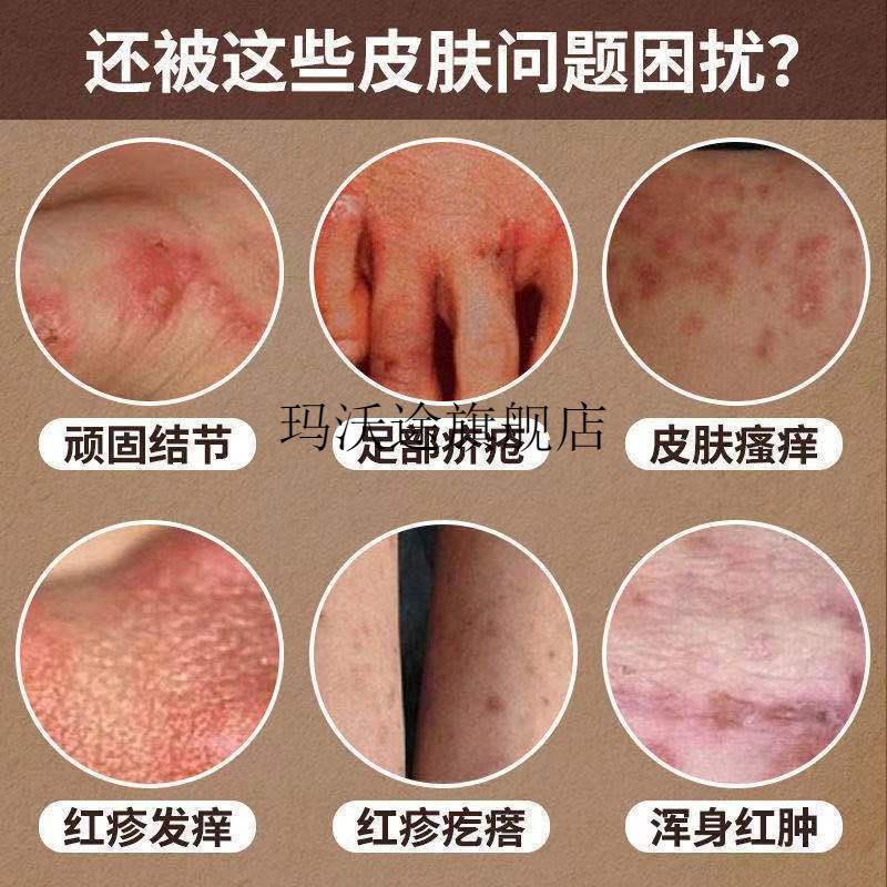 幸芙一号硫磺软膏皮肤瘙痒止痒螨虫过敏乳膏 硫磺软膏10支【图片 价格