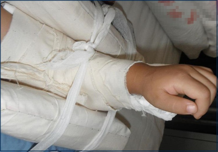 儿童型手臂肘部固定支具上肢肘关节吊带夹板扭伤肱骨支