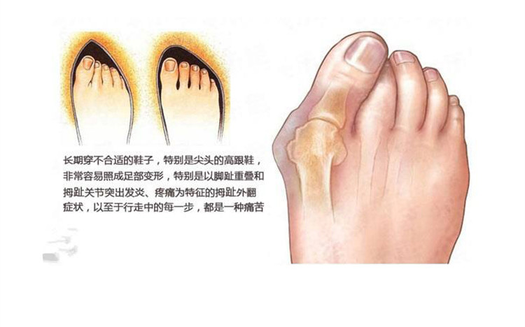 大拇指外翻纠正男女士大脚骨矫正成人脚趾外拇外翻器趾骨姆趾足大脚趾