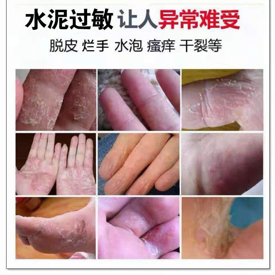 水泥过敏止痒膏建筑专用皮肤过敏手足脱皮干裂瘙痒红疙瘩水泡阴囊潮湿
