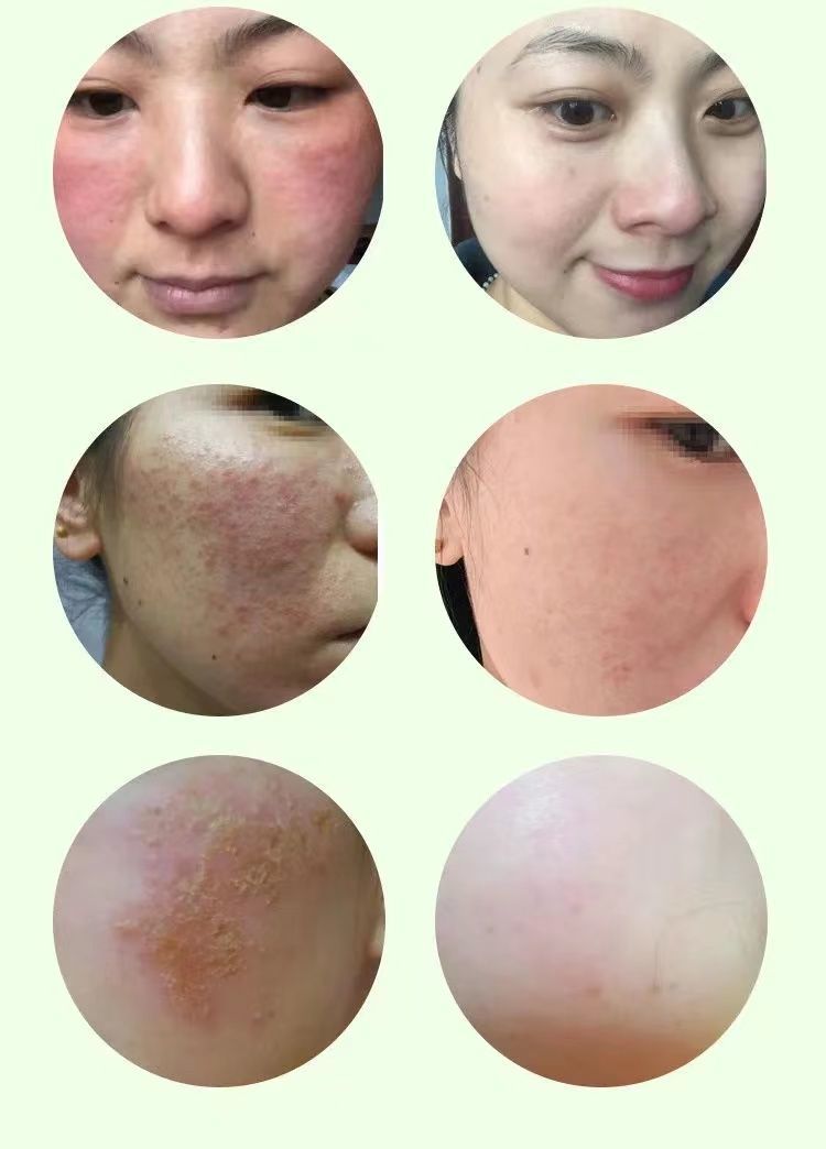 皮肤修复脸部紫外线抗过敏霜晒伤止痒修复膏 一盒舒敏康(20g)【图片