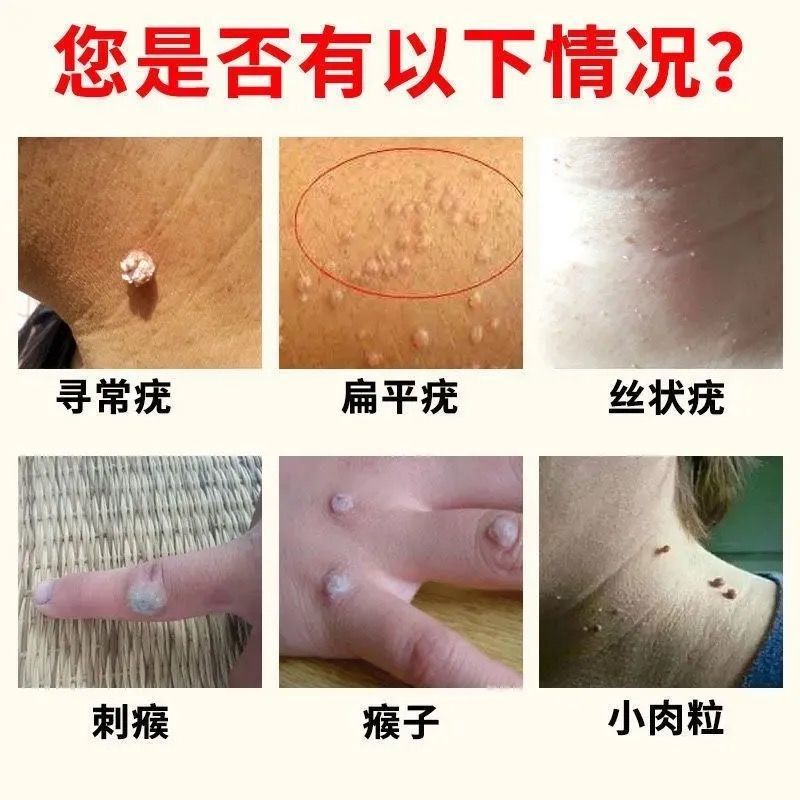 克疣液祛扁平丝状跖疣瘊子去猴子小肉粒疙瘩用药肉刺鱼鳞痣 快速去疣