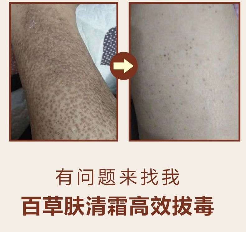 艾夫特百草膏芙贝乐百草肤清霜湿iii疹皮iii炎牛ii皮i荨i麻i疹大腿
