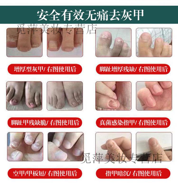 灰指甲【灰指甲液】专l用去增厚灰甲发黑分离液脱甲膏增l长液 一套