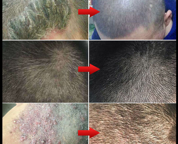 头i癣去屑止痒洗发水除螨虫头皮ii癣洗头膏大块头皮屑控油防i脱洗发露