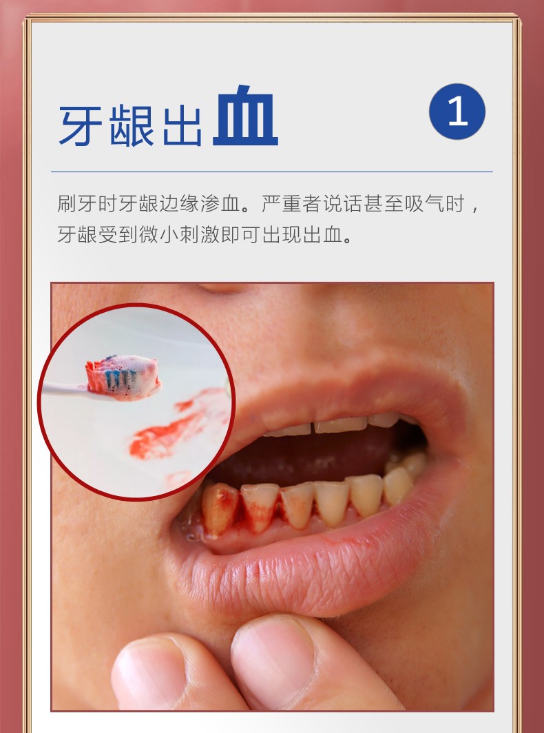 舒牙膏牙龈萎缩牙齿松动牙结石口腔溃疡牙周牙龈肿痛出血牙菌斑韩婵tt