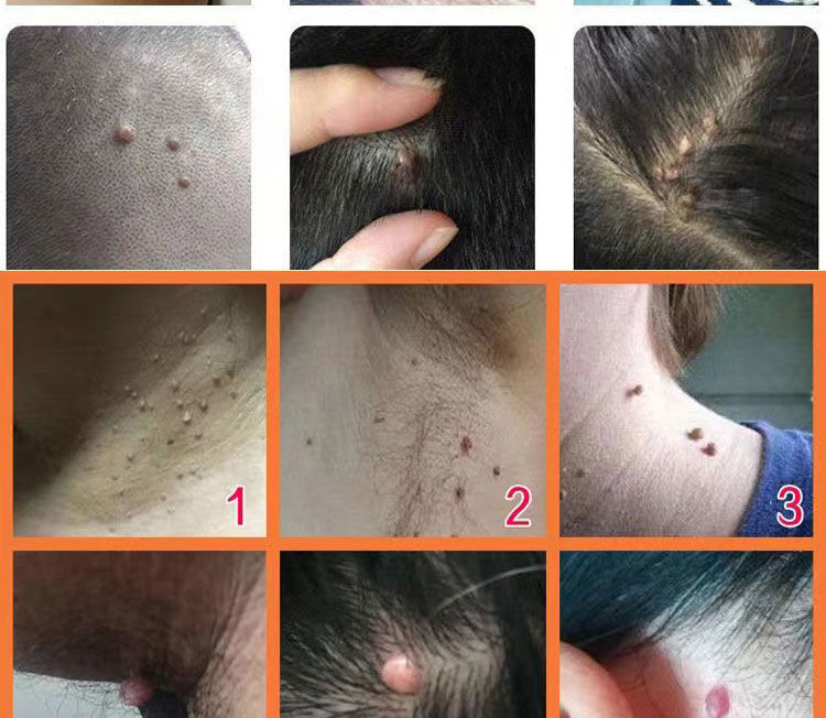 灵去除颈部小肉粒疙瘩男女通用脸部痦子黑痣皮赘5ml脸上脖子头上专用