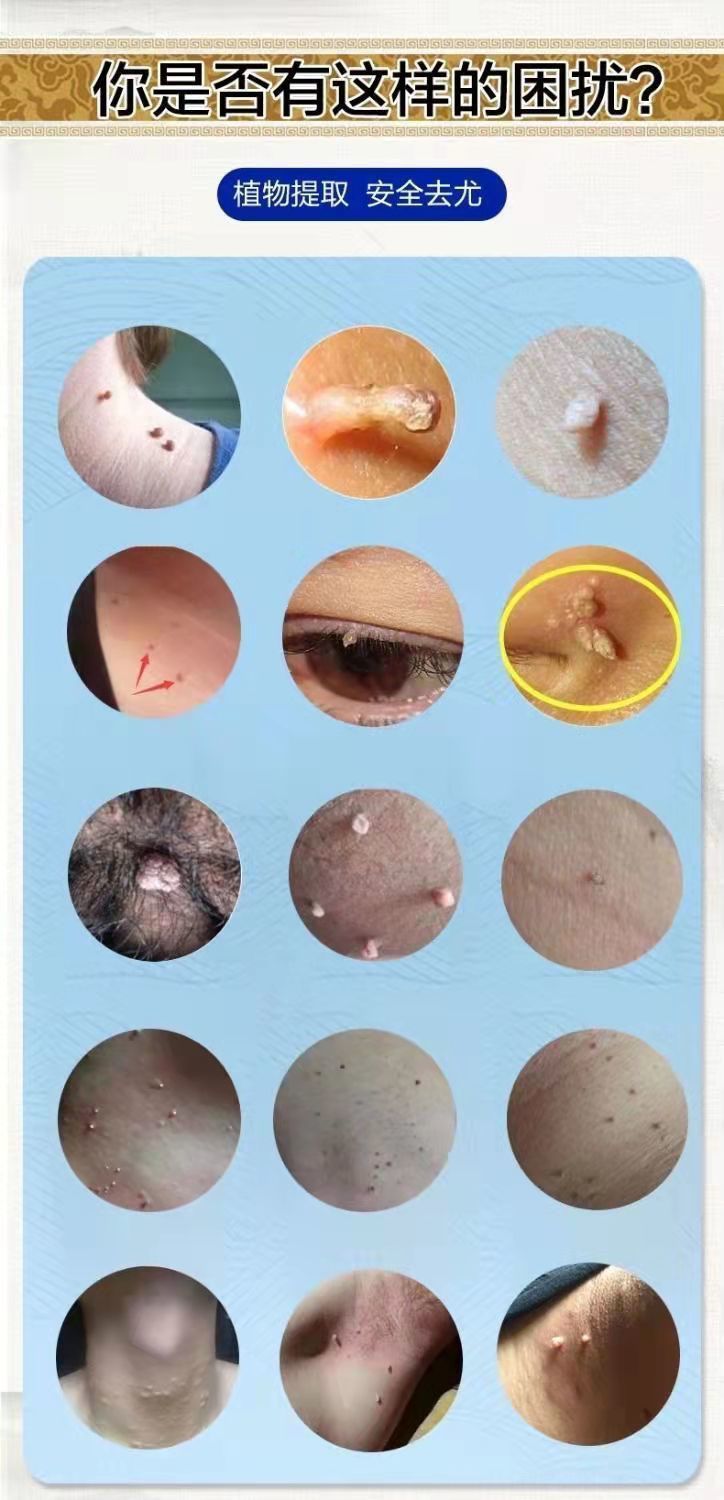 克l尤膏去扁平i疣神器膏肉i刺猴子去i疣灵病毒疣克星 克i疣膏 5盒巩固