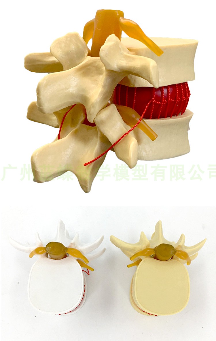 腰椎间盘模型图图片