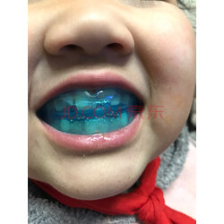 儿童地包天牙套