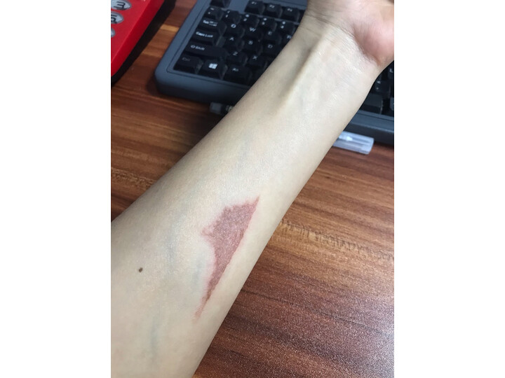 用这个不小心烫手上去了,一个疤出来了,真难受