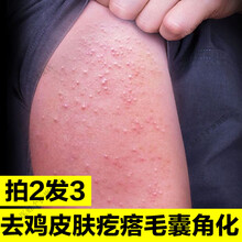 鸡皮肤治疗会脱皮发痒吗(鸡皮肤治疗会脱皮发痒吗图片)