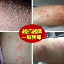 全身痒起红疙瘩价格报价行情 京东
