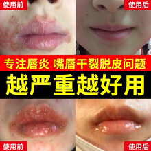 嘴唇起泡新款 嘴唇起泡21年新款 京东