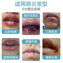 上嘴唇干裂新款 上嘴唇干裂21年新款 京东