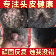 有头皮屑价格报价行情 京东