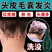 脂溢性头皮洗发水新款 脂溢性头皮洗发水21年新款 京东