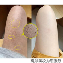 鸡皮疙瘩长汗毛了会好吗(鸡皮疙瘩长汗毛了会好吗图片)