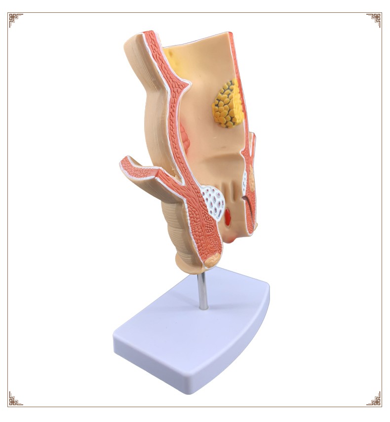 卓越 直肠痔疮病变模型痔疮内外解剖 肛门肛肠科大肠直肠病理教学模型