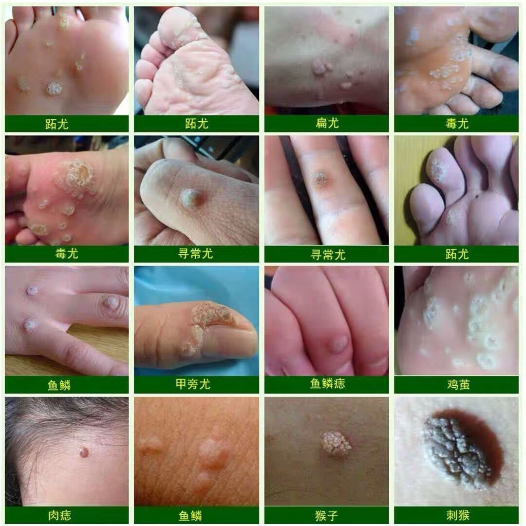 【京东健康大药房】一擦就掉】瘊子肉刺扁平尤无痛去脖子小肉粒丝状尤