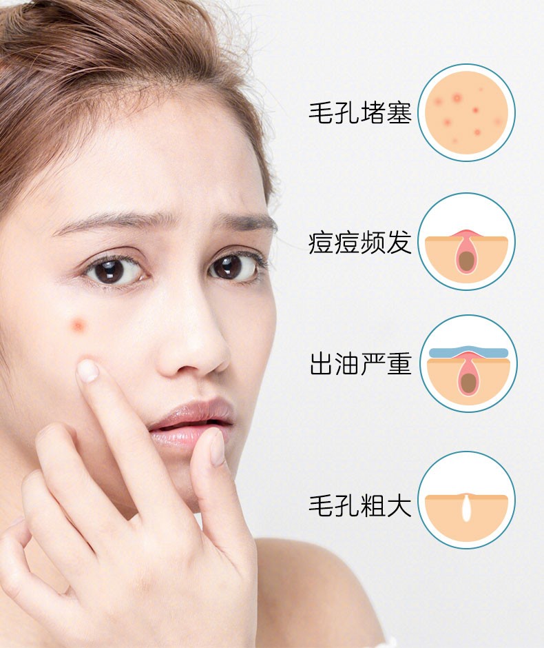 姗拉娜祛痘凝胶 祛痘膏青春痘学生祛痘印痘坑男女淡化痘印膏 植优金典