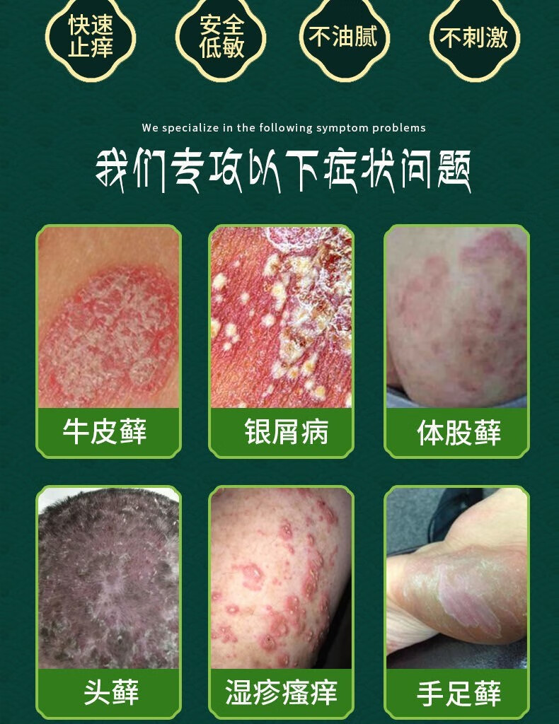 【药房直发】牛皮癣湿疹皮肤病头癣瘙痒银屑病特效荨麻止痒药膏汗疱疹