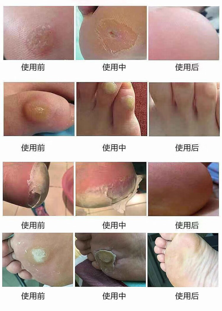 鸡眼膏根脚趾手足脚底老茧跖疣肉刺手上瘊子脚垫手足死皮鸡眼膏脚喷剂