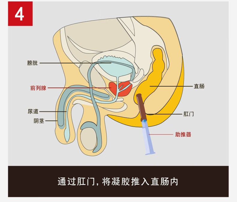 修正 前列腺炎冷敷凝胶 抗菌前列安栓高效单体银尿频尿急尿痛尿不尽