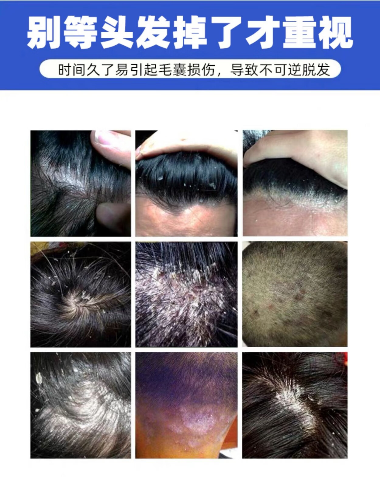 草木颂专治大块头皮屑毛囊洗发专治头皮屑癣藓头皮痒头发毛囊软膏头部