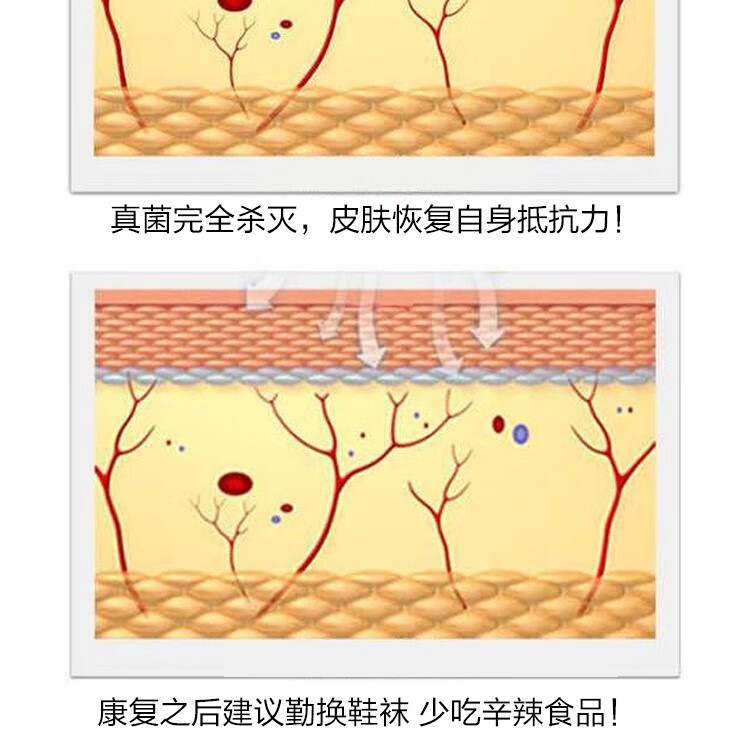 斧标远红臭痒康足光脚气喷剂烂角丫奇痒脱皮脚臭水泡脚出汗斧标国际佰