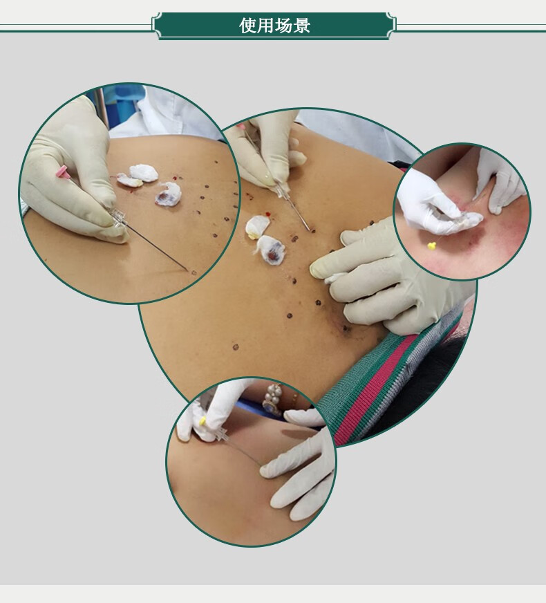 埋易康埋线针一次性使用可吸收胶原蛋白线埋线减肥溶脂埋线器中医穴位