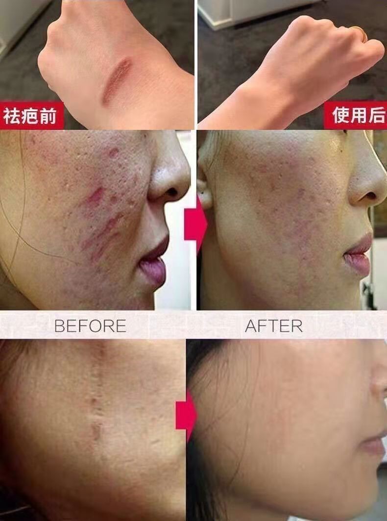 【京东大药房直发】去疤膏去疤痕修复无痕脸上腿部手术疤痕烫伤印修复