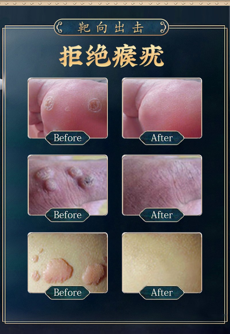扁平疣尖锐湿疣去丝状疣寻常疣去肉粒刺猴子去疣脖子颈部必治可搭5