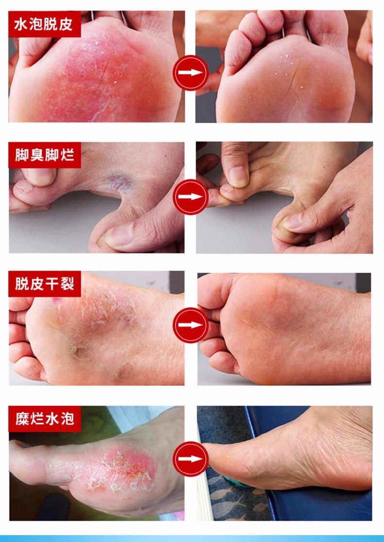 唯达宁 脚气喷雾硝酸益康唑喷剂 1%*80ml/瓶 真菌感染去脚气股癣体癣