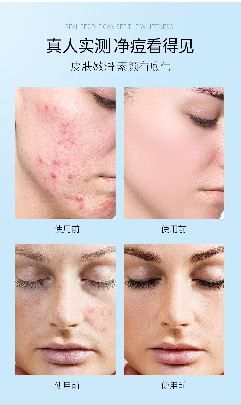 祛闭口粉刺黑头收缩毛孔男女士玻尿酸保湿补水面膜 仁和祛痘净颜面膜